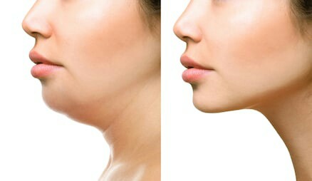 maschera per eliminare il doppio mento, maschera per eliminare il doppio mento